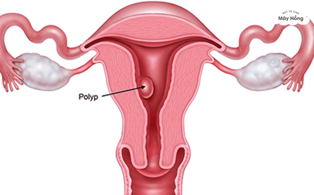vị trí của polyp cổ tử cung