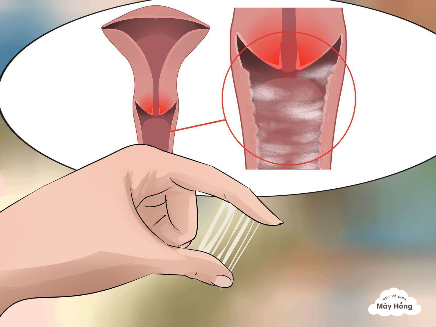 Viêm nhiễm âm đạo có mang thai được không?